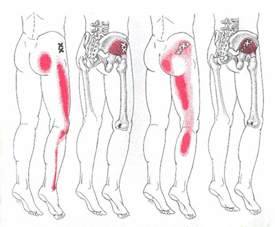 tight gluteus medius